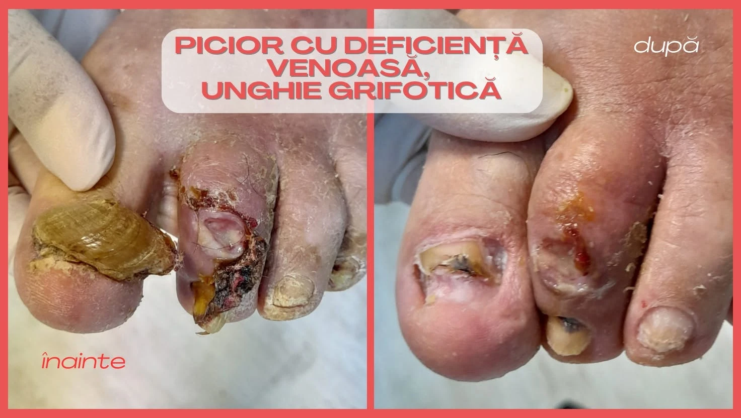 Picior cu insuficiență venoasă și unghie grifotică - înainte și după îngrijire